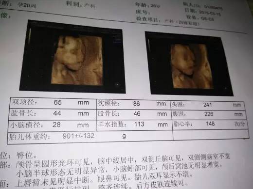 唐氏综合症_唐氏综综合图片_囤积症对应的是什么症