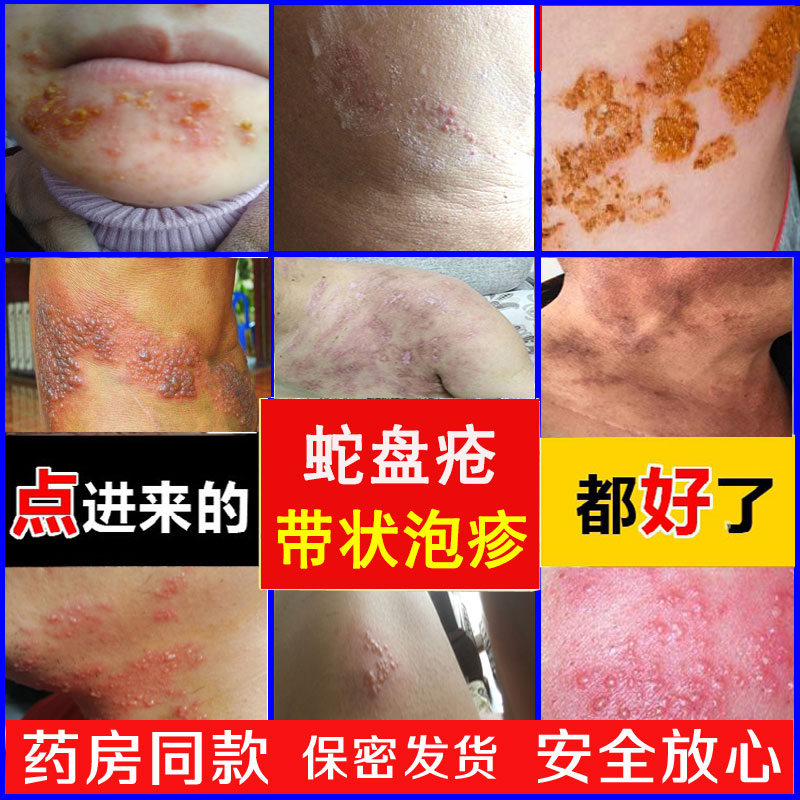 单纯疱疹病毒性脑炎_单纯疱疹病毒_单纯病毒疱疹抗体igm