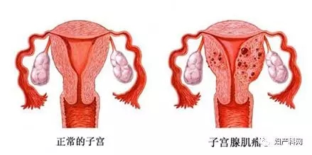 子宫腺肌症_子宫腺肌症症如何受孕_子宫腺肌症的症状