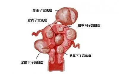 子宫腺肌症_子宫腺肌症与腺肌瘤_子宫腺肌症的治疗