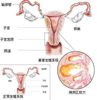 子宫腺肌症的治疗方法