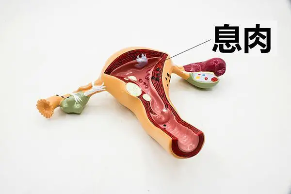 巧克力囊肿