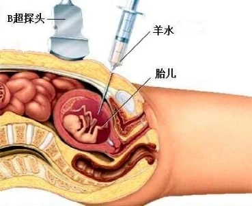 唐氏综合筛查是什么_唐氏综合症_囤积症对应的是什么症