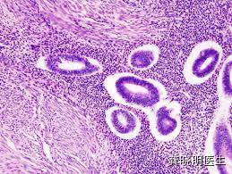 子宫腺肌症