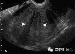 子宫腺肌症