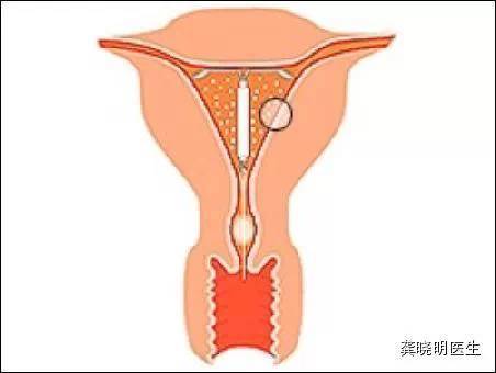 子宫腺肌症