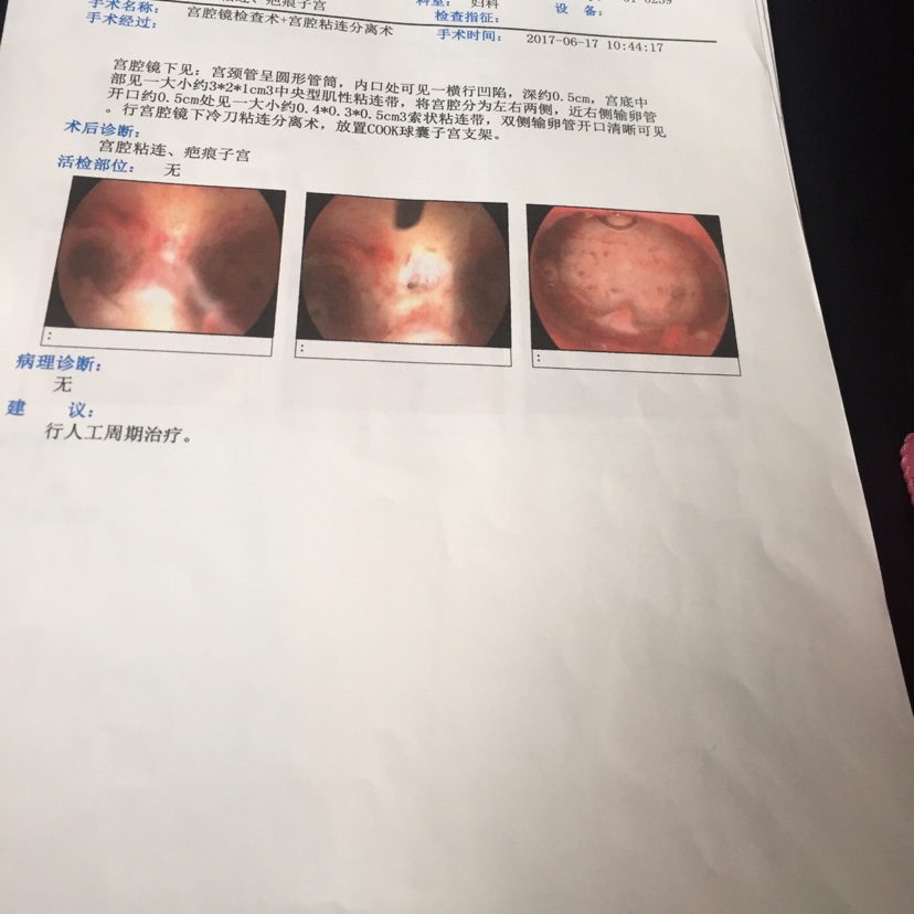 宫腹腔镜联合手术防止粘连_宫腔粘连_宫颈口粘连扩宫