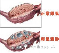 巧克力囊肿