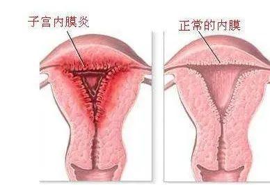 什么叫宫腔镜检查_宫腔镜检查_宫腔镜检查后