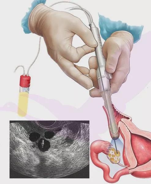 试管前宫腔镜检查_宫腔镜检查_什么是宫腔镜检查