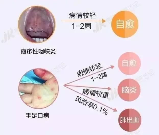 单纯疱疹性病毒_复发性单纯疱疹_单纯疱疹病毒