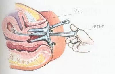 子宫肌腺症 子宫腺肌症_子宫腺肌症_子宫腺肌症症如何受孕