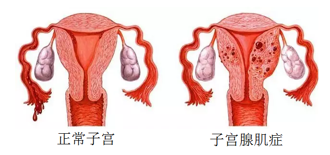 子宫腺肌症