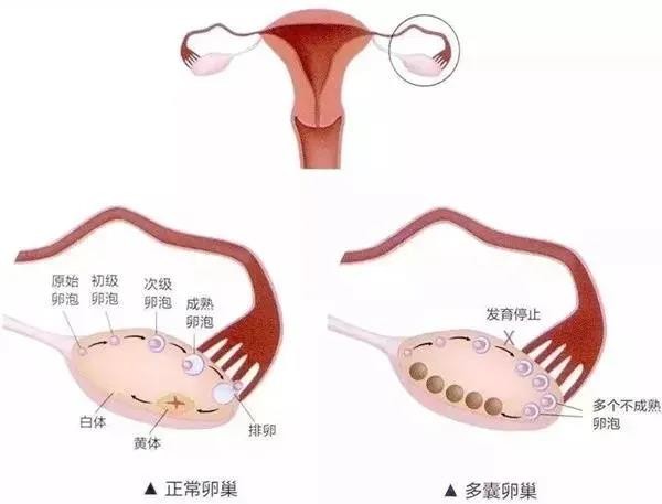 卵泡期用洗手液影响卵泡发育吗_卵泡与卵泡囊肿_窦卵泡计数