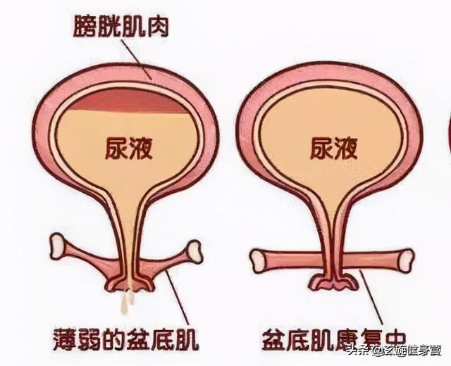 盆底肌康复治疗仪_盆底肌康复训练_盆底肌修复