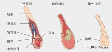 睾丸扭转