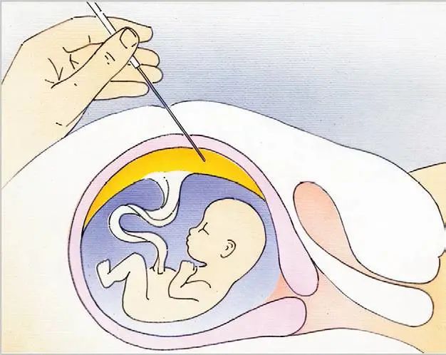 宫腔镜检查_试管前宫腔镜检查_宫腔镜检查?
