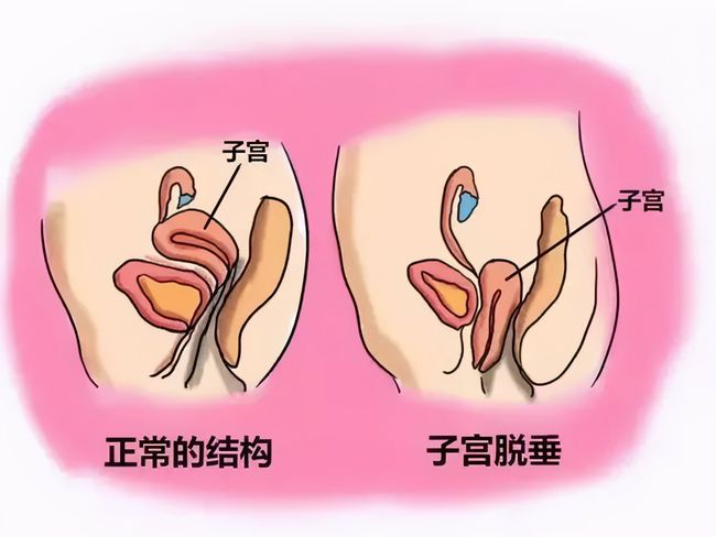 盆底肌康复_盆底肌修复_盆底肌康复治疗仪