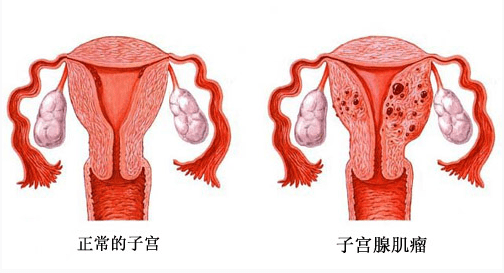 子宫腺肌症的症状_子宫腺肌症怎么治疗_子宫腺肌症