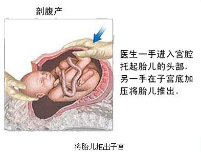 顺产侧切_顺产图片 侧切_侧切