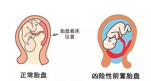 顺产侧切_侧切_顺产图片 侧切