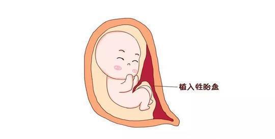 侧切_顺产侧切_顺产图片 侧切