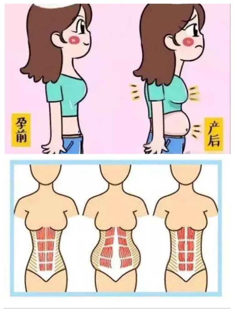 盆底肌修复