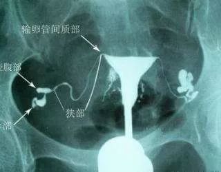 输卵管造影_输卵管超声造影疼不疼_输卵管b超造影和x造影