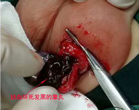 睾丸扭转坏死_睾丸扭转_睾丸扭转