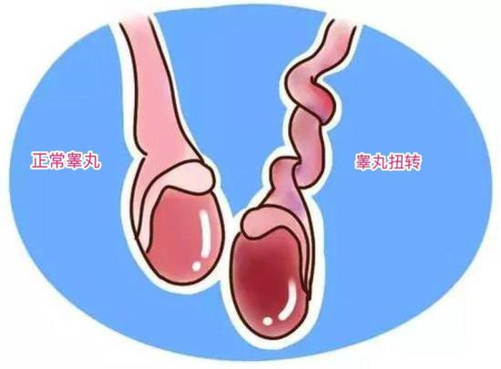 睾丸扭转_睾丸扭转手术_睾丸扭转原因