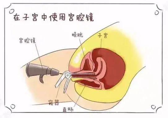 宫腔镜检查_什么叫宫腔镜检查_宫腔镜检查