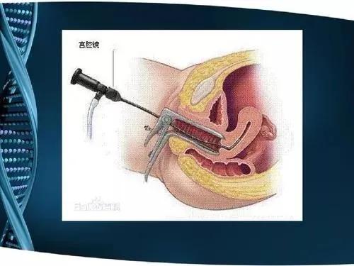 宫腔镜检查_宫腔镜检查_什么叫宫腔镜检查