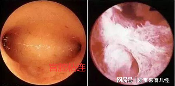 重度宮腔粘连图片_宫腹腔镜联合手术防止粘连_宫腔粘连