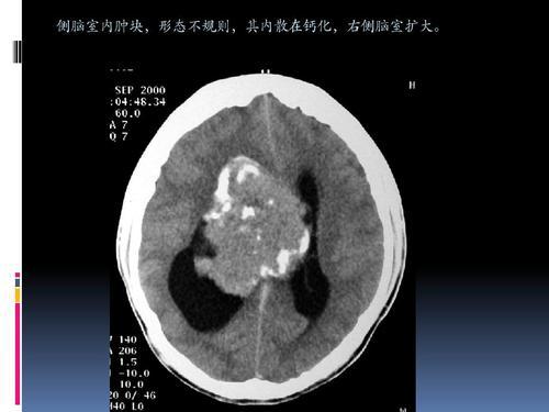 特纳氏综合症是遗传病吗_马凡氏综合症_南山南马頴有早衰症么