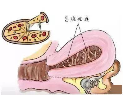 宫腔粘连