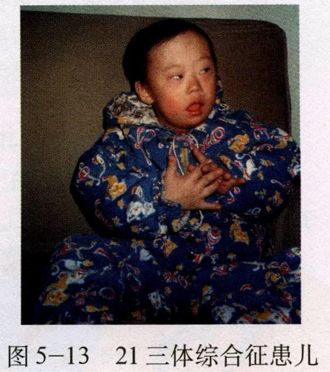 唐氏综合症_唐氏总和症_唐氏综合筛查是什么意思