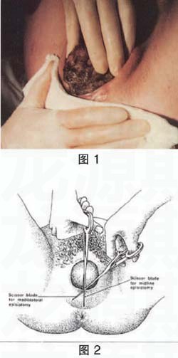 会阴侧切的术后护理及并发症处理方法