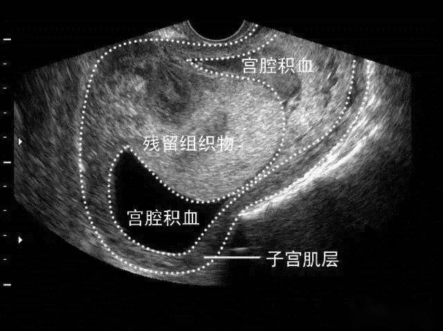 坐小月子注意事项_小月子_流产小月子注意事项