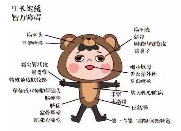 唐氏综合症
