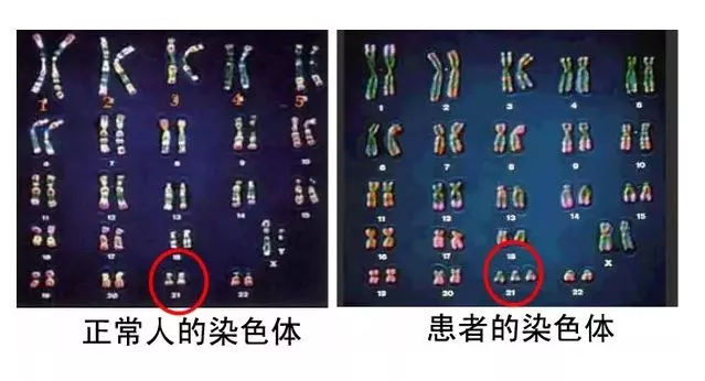 唐氏综合症