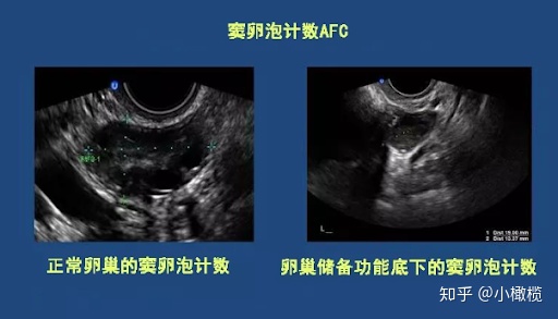 窦卵泡计数