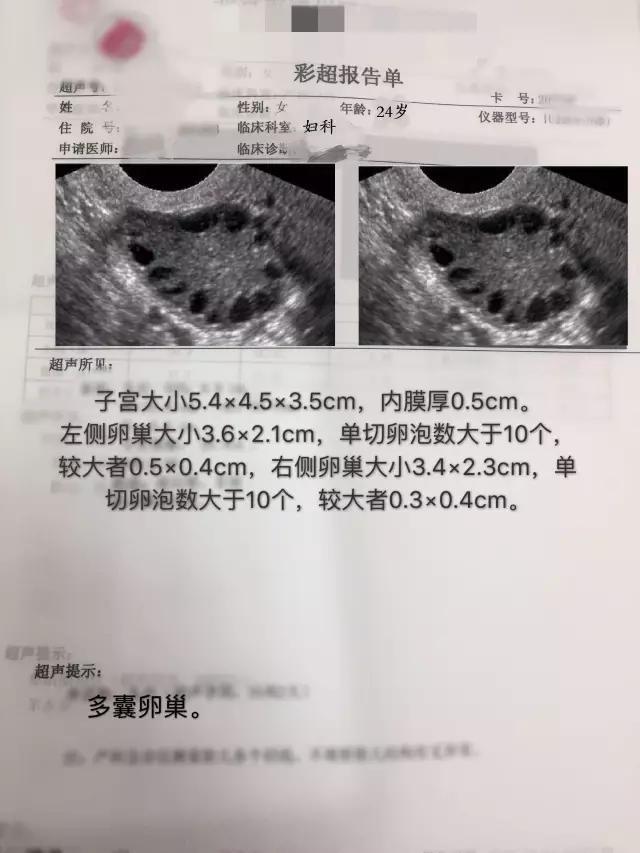 窦卵泡计数_卵泡期雌二醇偏高促卵泡成熟激素偏低怎么办_穿刺大卵泡,小卵泡能长大吗