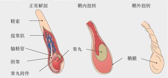 睾丸扭转_睾丸扭转原因_睾丸扭转症状