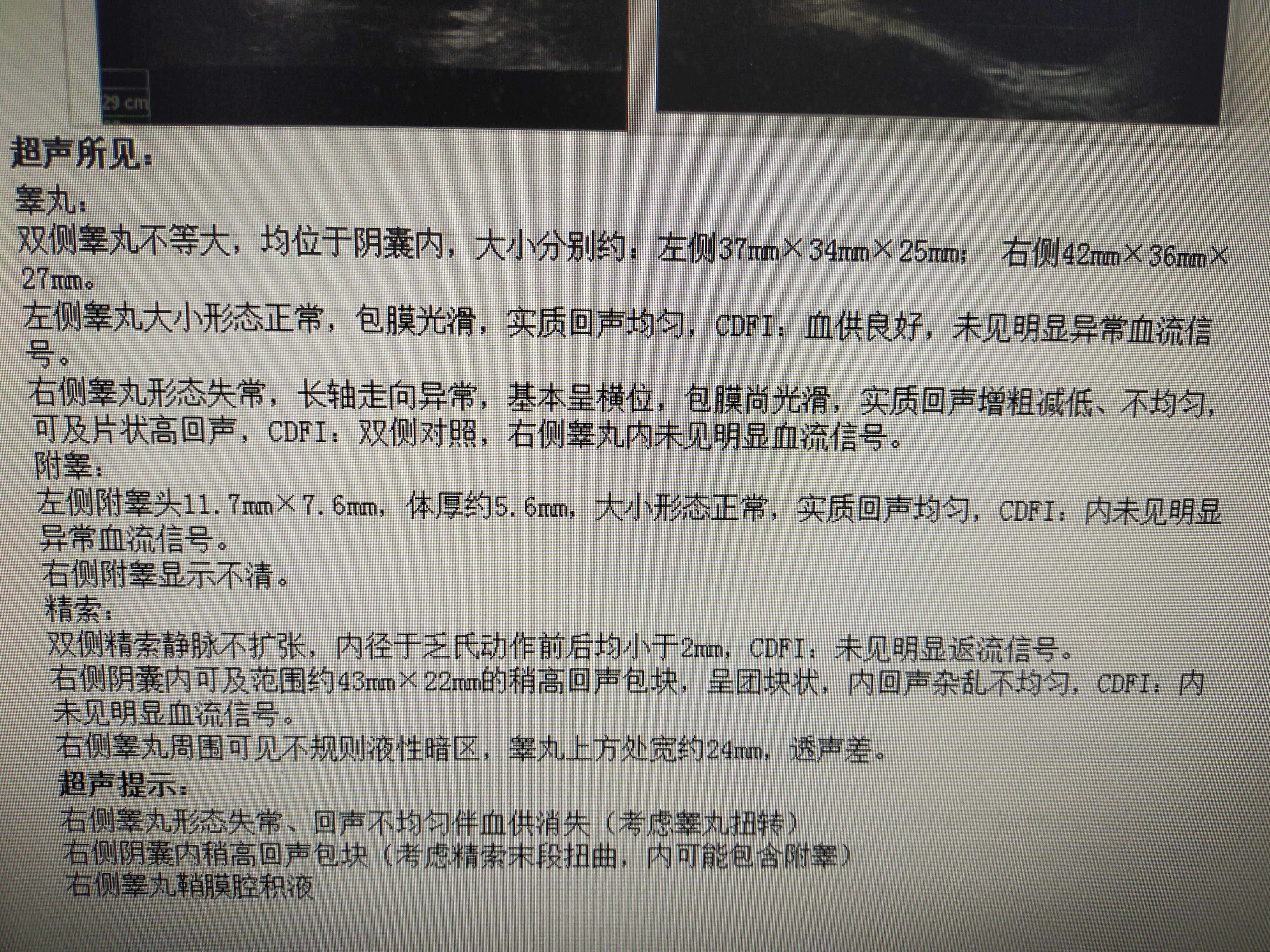 睾丸扭转