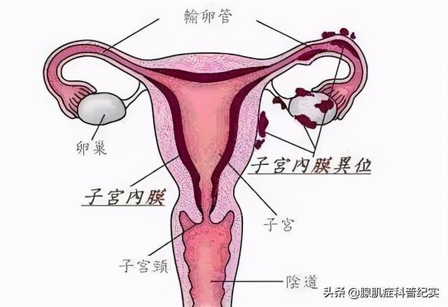 子宫腺肌症的治疗_子宫腺肌症_子宫腺肌症症怎么怀孕
