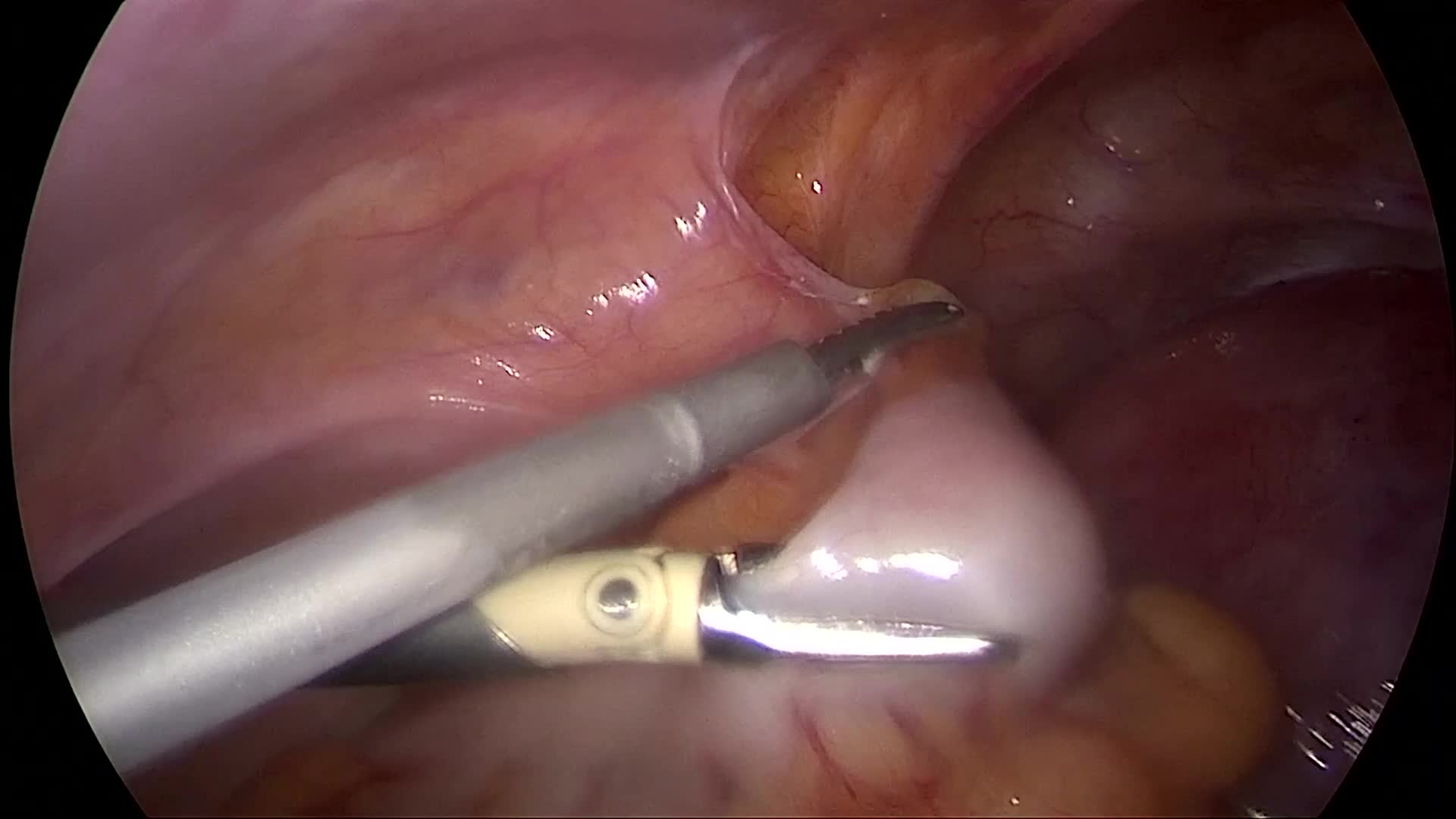 子宫腺肌症