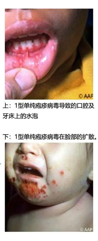 单纯疱疹病毒_单纯疱疹病毒感染_单纯疱疹Ⅰ/Ⅱ型病毒igm抗体