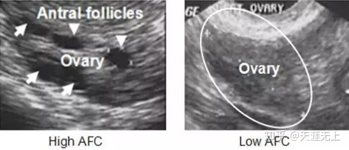 窦卵泡计数