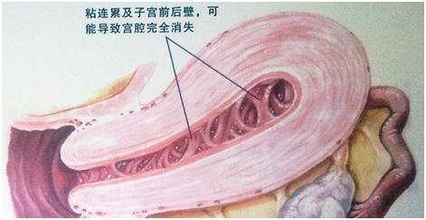 阑尾粘连肠子粘连_宫腔粘连_宫颈口粘连扩宫