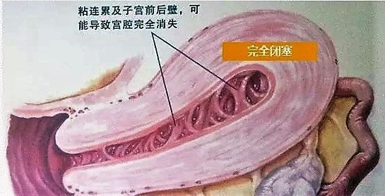 宫腔粘连